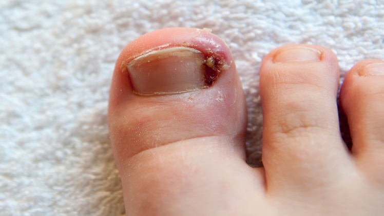 How to Deal With an Ingrown Toenail