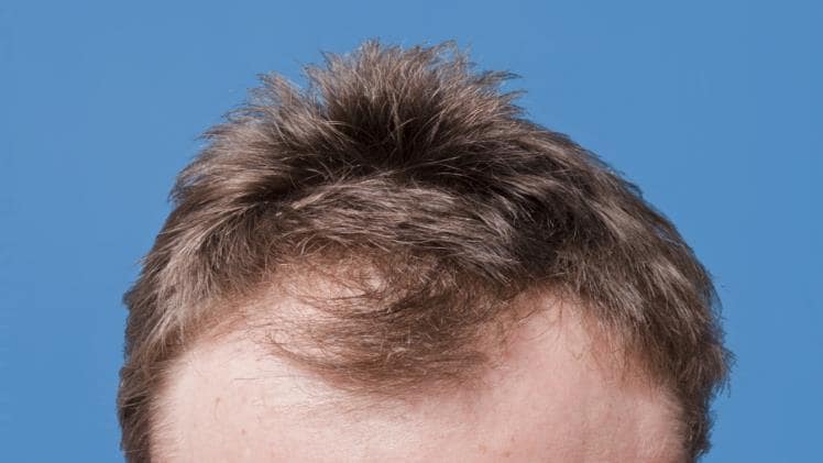 The Best Ways To Optimize Your Hair Growth With Minoxidil